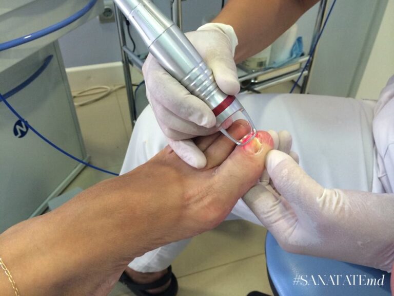 Лечение грибка ногтей лазером в клинике TerraMed