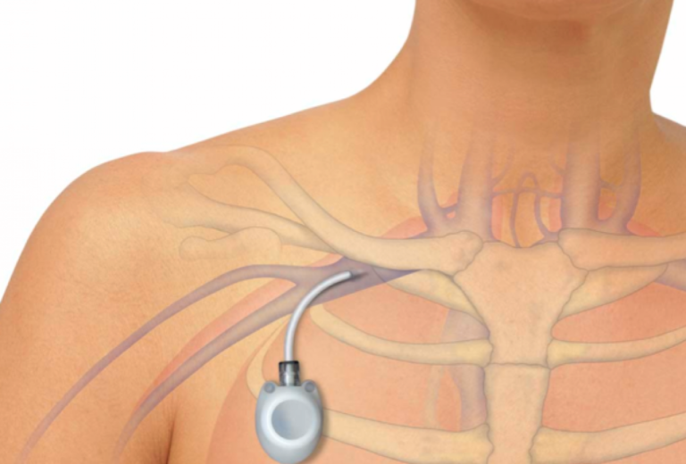 Эксклюзивная имплантируемая система для проведения химиотерапии в Medpark