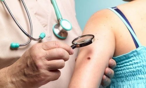 alfa diagnostica диагностика рака кожи