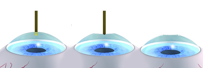 Cât de sigure sunt operațiile laser pentru ochi?