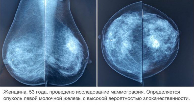 Узел в молочной железе — что делать?