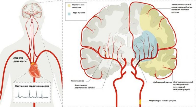 Инсульт: Лечение, профилактика и нейрореабилитация