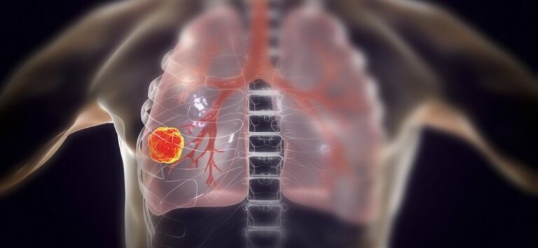 60 de mii de moldoveni diagnosticați cu cancer în 2020, tumorile maligne cele mai răspândite