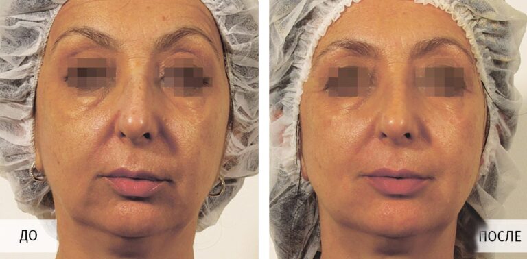 GeneO+ безопасное омоложение и оксигенация кожи