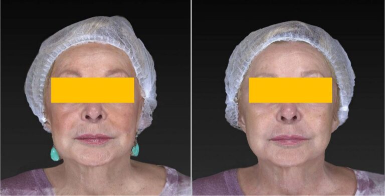 ULTHERAPY «золотой стандарт» нехирургического SMAS-лифтинга