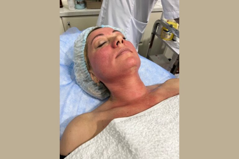 Зачем нужен пилинг? 