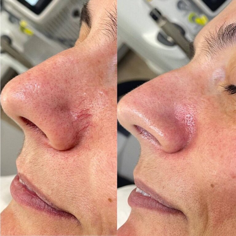 Лазерное удаление сосудов. Купероз